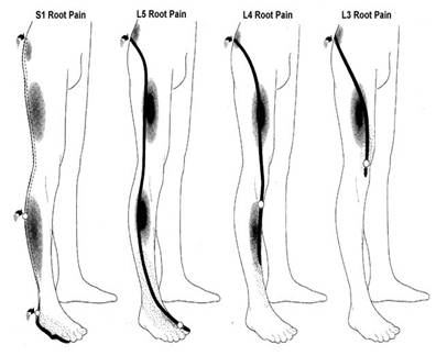 Nerve Root Pain and Disc Prolapse – Warwick Physio + Rehab